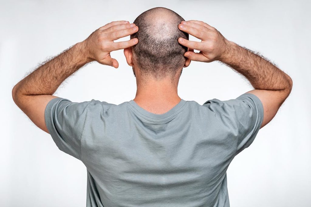 Alopecia psicogena cos è e quali sono i sintomi MedicinaLive