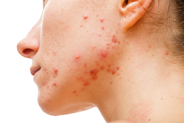 trattamenti per macchie da acne