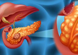 Tumore Al Pancreas | MedicinaLive